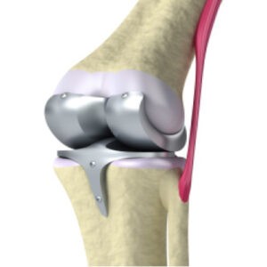 ARTROPLASTÍA RODILLA